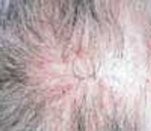 Lichen Planopilaris With Abrupt Onset of Rapid Hair Loss