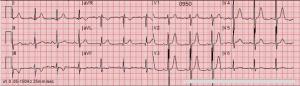 Chest Pain in an Adult Male With an Ominous ECG