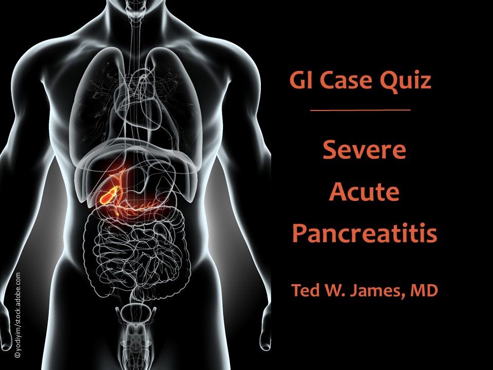 Pancreatic necrosis, nasojejunal feeding, post-pyloric tube