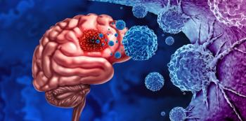 Image credit: freshidea | stock.adobe.com. Glioma Cancer Tumor as malignant cells outbreak as a brain disease attacking neurons as a medical concept of neurological disease