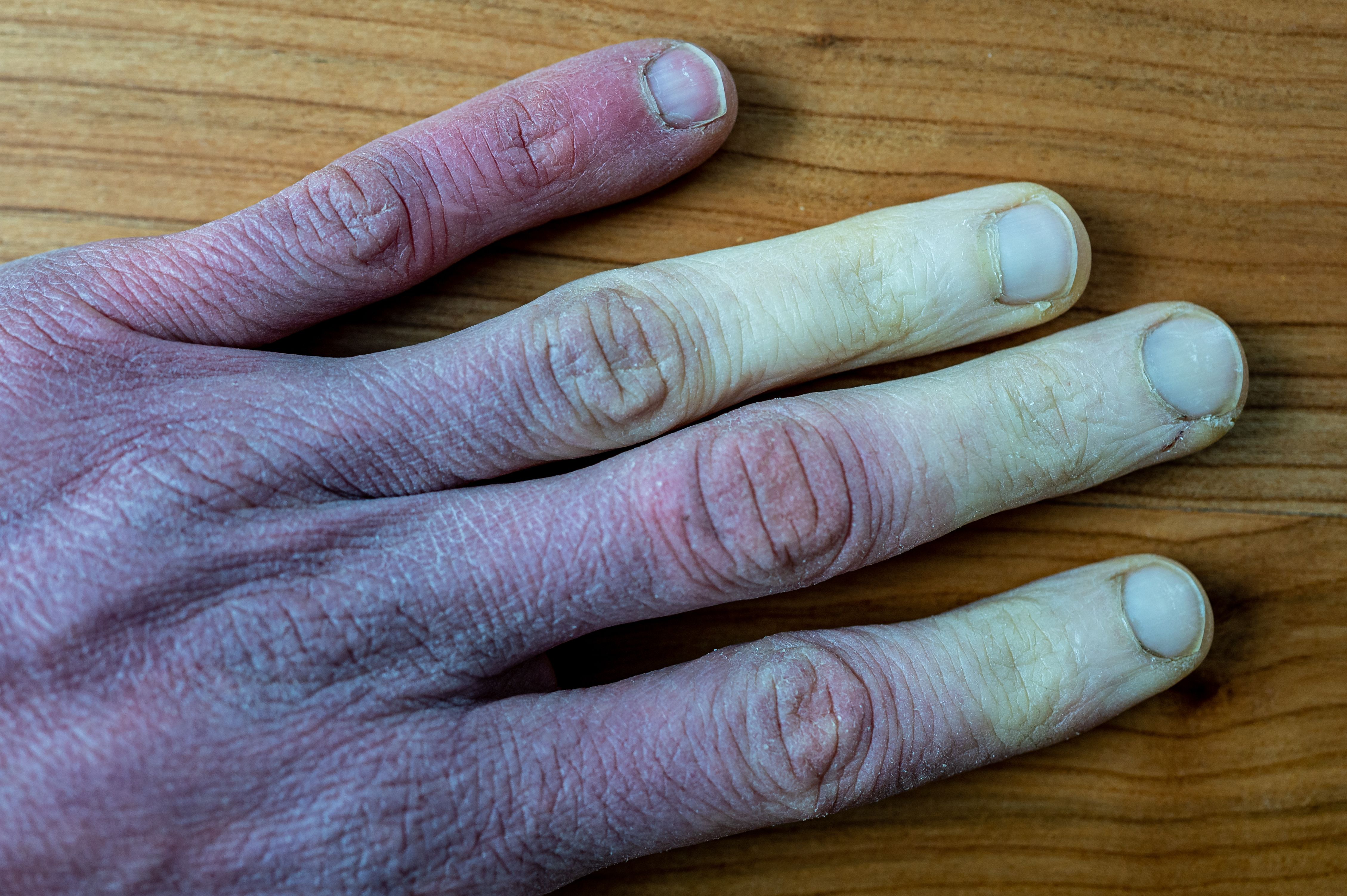 Image credit: Szymon Bartosz | stock.adobe.com. Severe frostbite treatment
