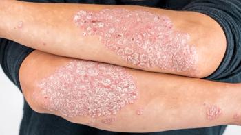 Image credit: fusssergei | stock.adobe.com. Man with sick hands, dry flaky skin on his hand with vulgar psoriasis, eczema and other skin diseases such as fungus, plaque, rash and blemishes. Autoimmune genetic disease