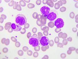 FDA Grants Fast Track Designation to Aptose’s HM43239 for Acute Myeloid Leukemia