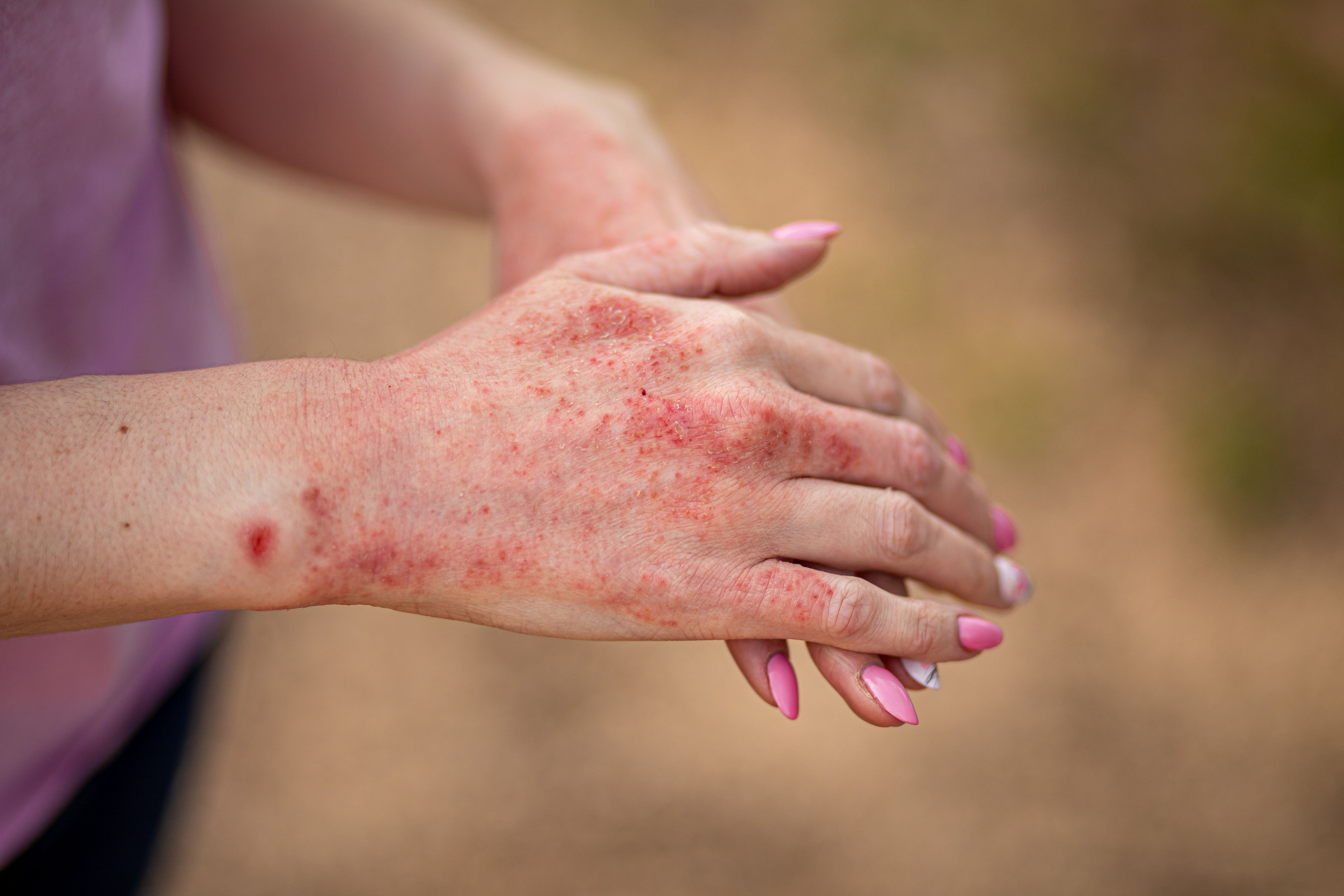 Woman with atopic dermatitis on hands -- Image credit: InfiniteStudio | stock.adobe.com