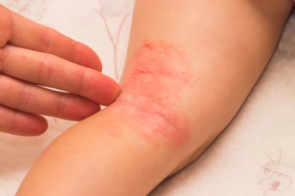 Atopic dermatitis (AD) on child -- Image credit: dmitrypk | stock.adobe.com