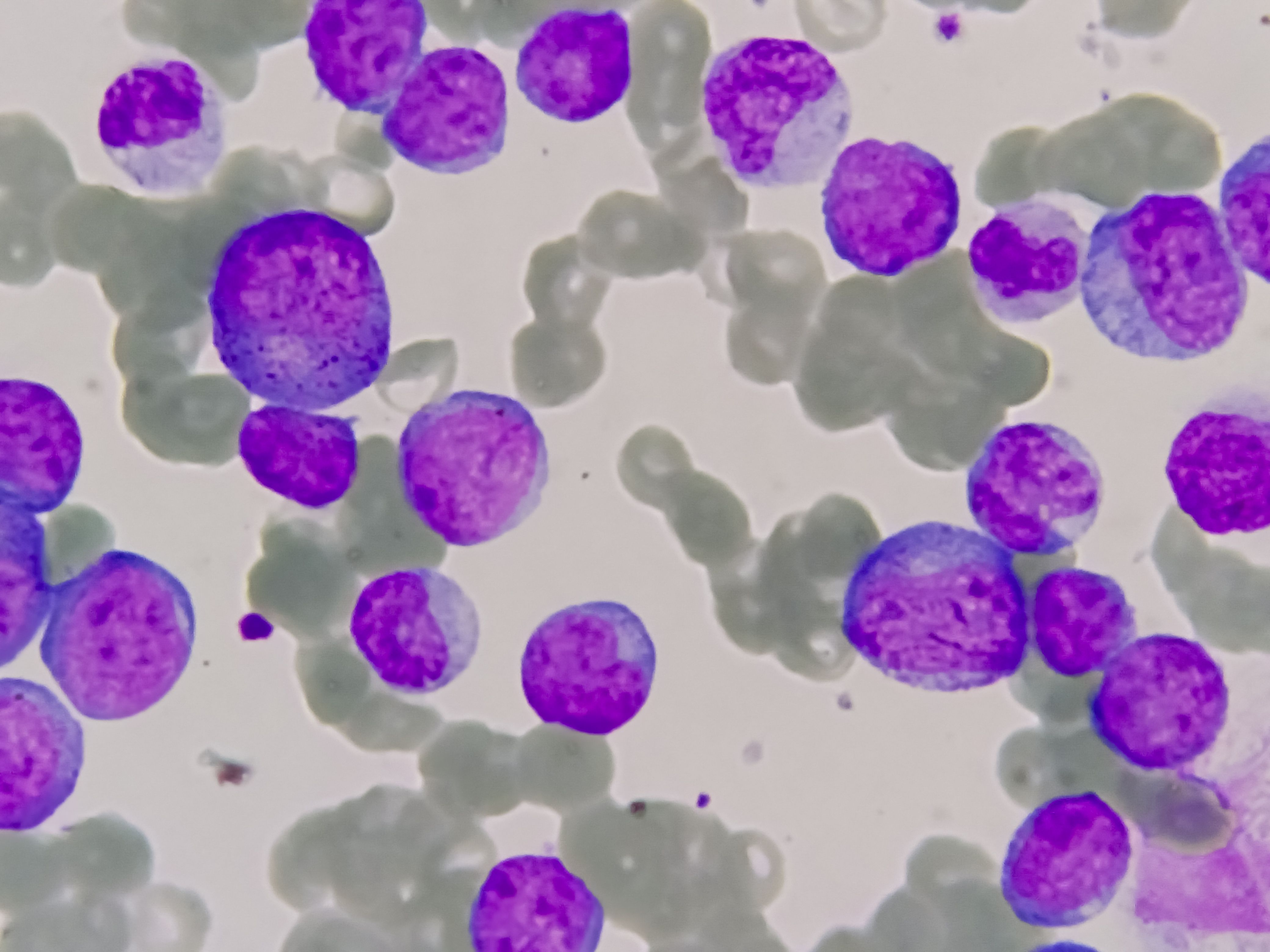 Acute leukemia -- Image credit: Arif Biswas | stock.adobe.com