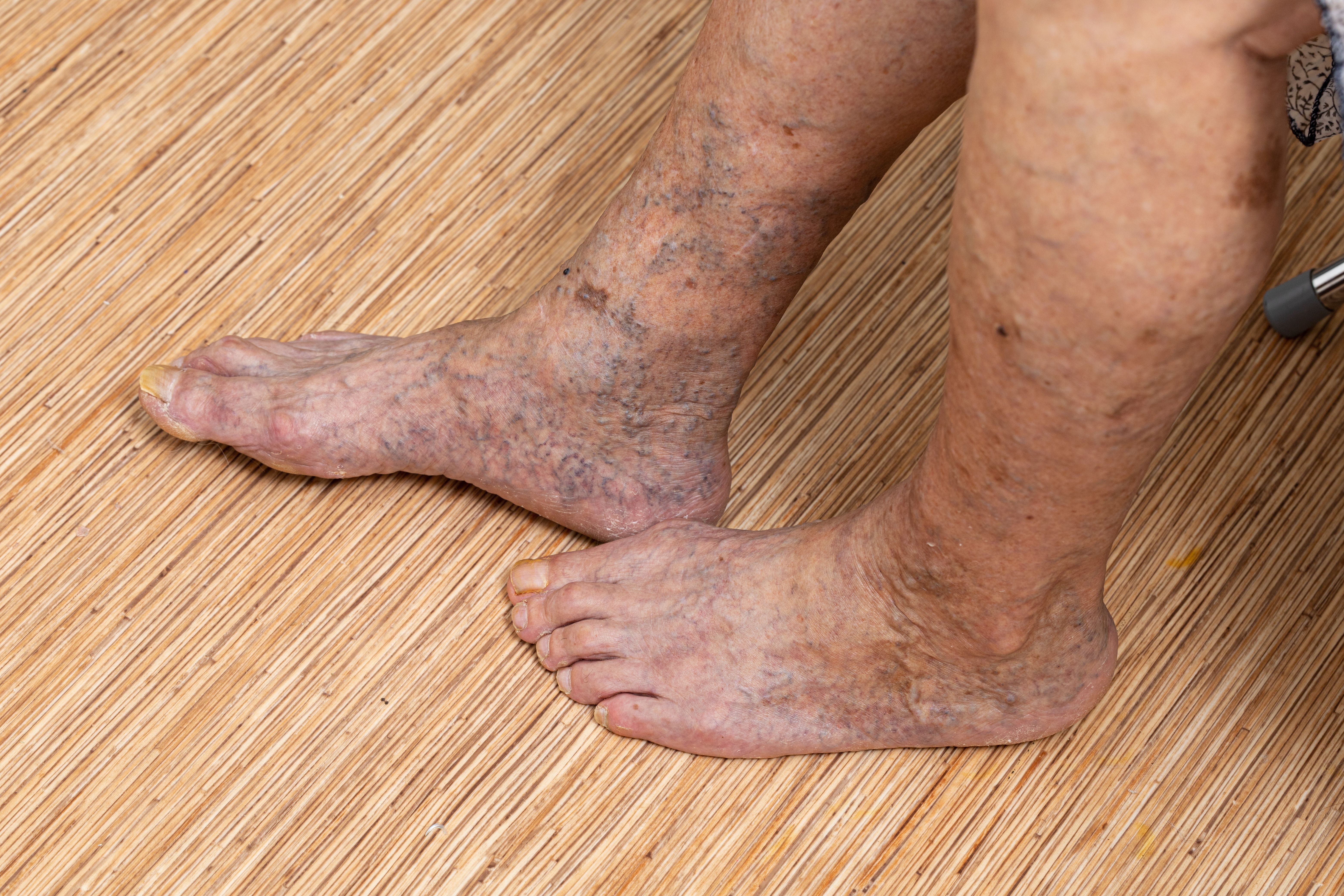 ACC 2025: Semaglutide Significantly Improves Walking Distance, Symptoms, QOL for Individuals with PAD and Diabetes