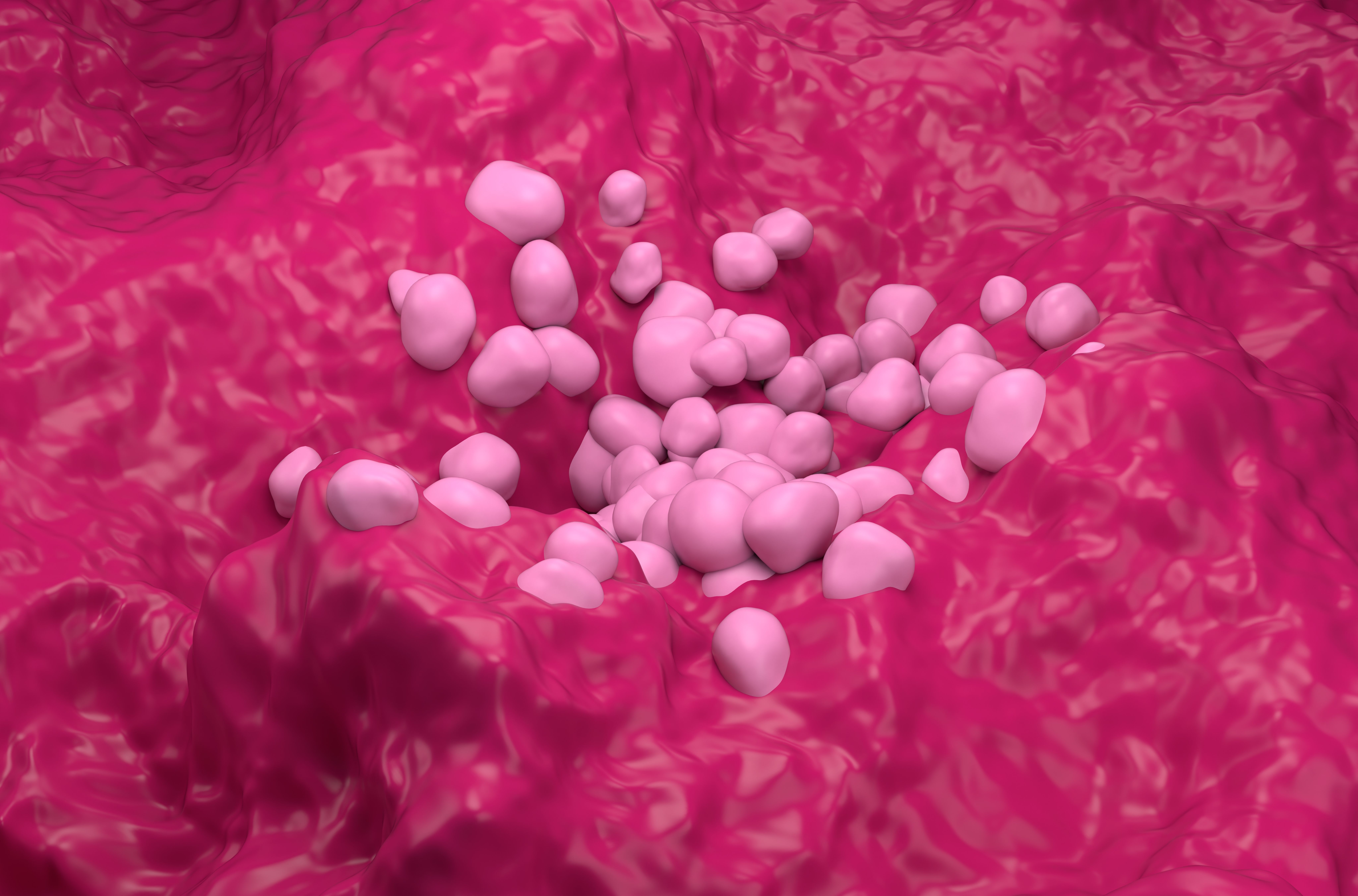 Non Small Cell Lung Cancer (NSCLC) in the lung tissue – isometric view 3d illustration - Image credit: LASZLO | stock.adobe.com