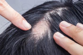 Alopecia Areata - Spot Baldness is a condition in which hair is lost from some or all areas of the body. | Image Credit: cattyphoto - stock.adobe.com