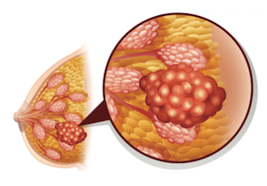 Advanced Breast Cancer