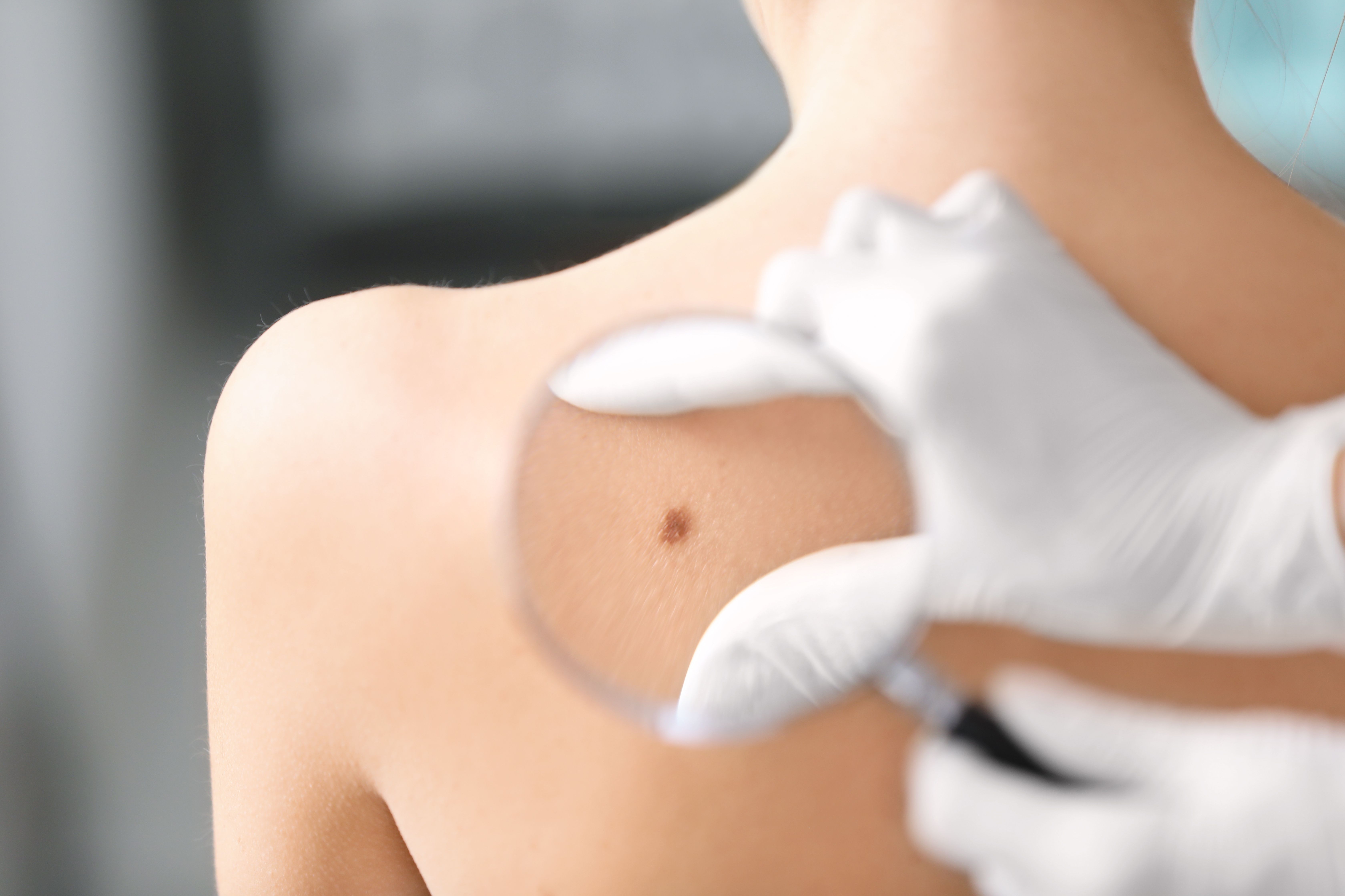 Physician examining a patient's mole