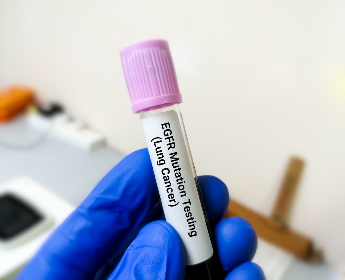 Molecular biologist holding blood sample for EGFR mutation test for the diagnosis of lung disease. Epidermal Growth Factor Receptor.