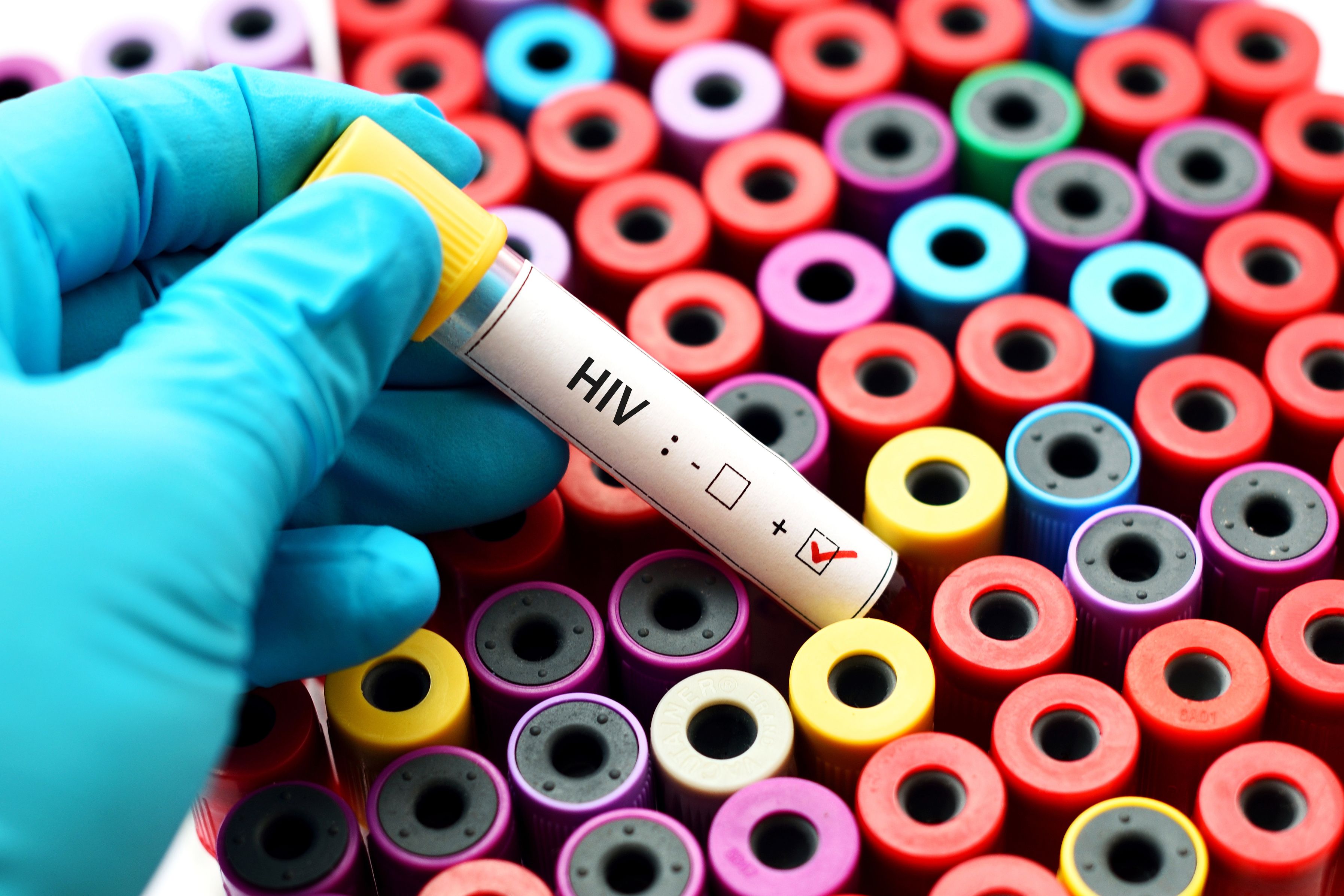 HIV positive blood sample - Image credit: jarun011 | stock.adobe.com