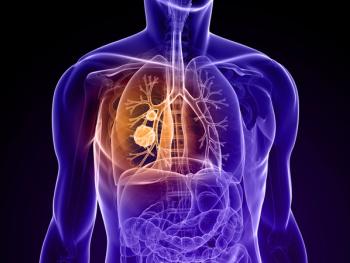 Non–small cell lung cancer (NSCLC) X-ray image -- Image credit: Sebastian Kaulitzki | stock.adobe.com
