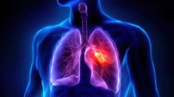 Medical illustration of Lung Cancer, a malignant tumor originating in lung tissue, mainly classified as non-small cell lung cancer and small cell lung cancer. Strongly associated with smoking, | Image Credit: tingyu | stock.adobe.com 