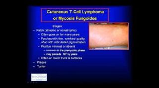 Atopic Dermatitis