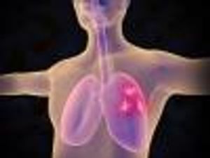 Post-Lung Surgery Opioid Prescriptions May Lead to Dependency