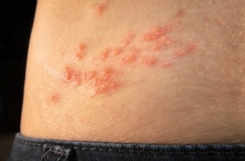 Shingles Infecton Pharmacy Clinical Pearl of the Day: Shingles Infection