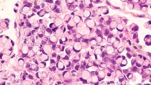 Does Multiple Myeloma Maintenance Therapy Need to Continue Indefinitely?