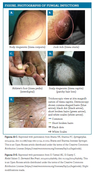 Identifying And Managing Fungal Skin Infections Identifying And Managing Fungal Skin Infections