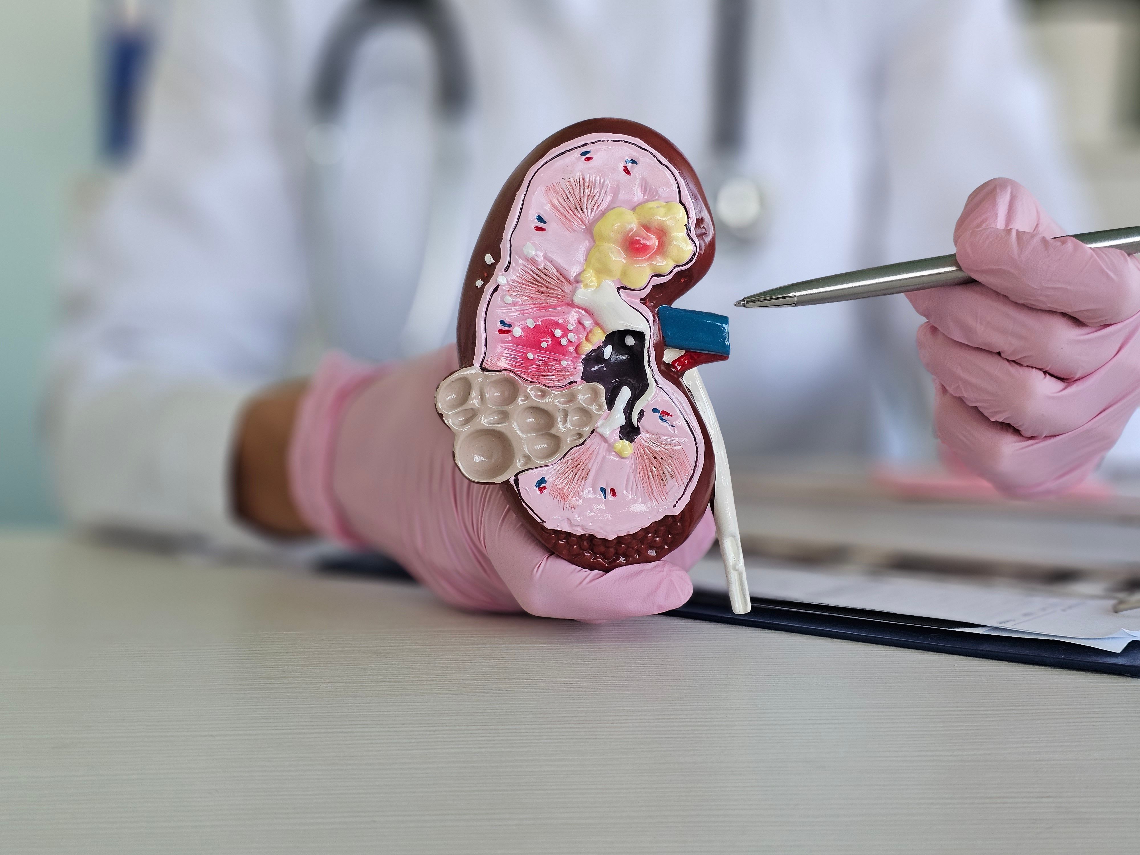 Model depicting chronic kidney disease (CKD) -- Image credit: Nadzeya | stock.adobe.com