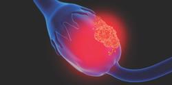 Olaparib as Maintenance Drug Reduces Disease Progression for Advanced Ovarian Cancer