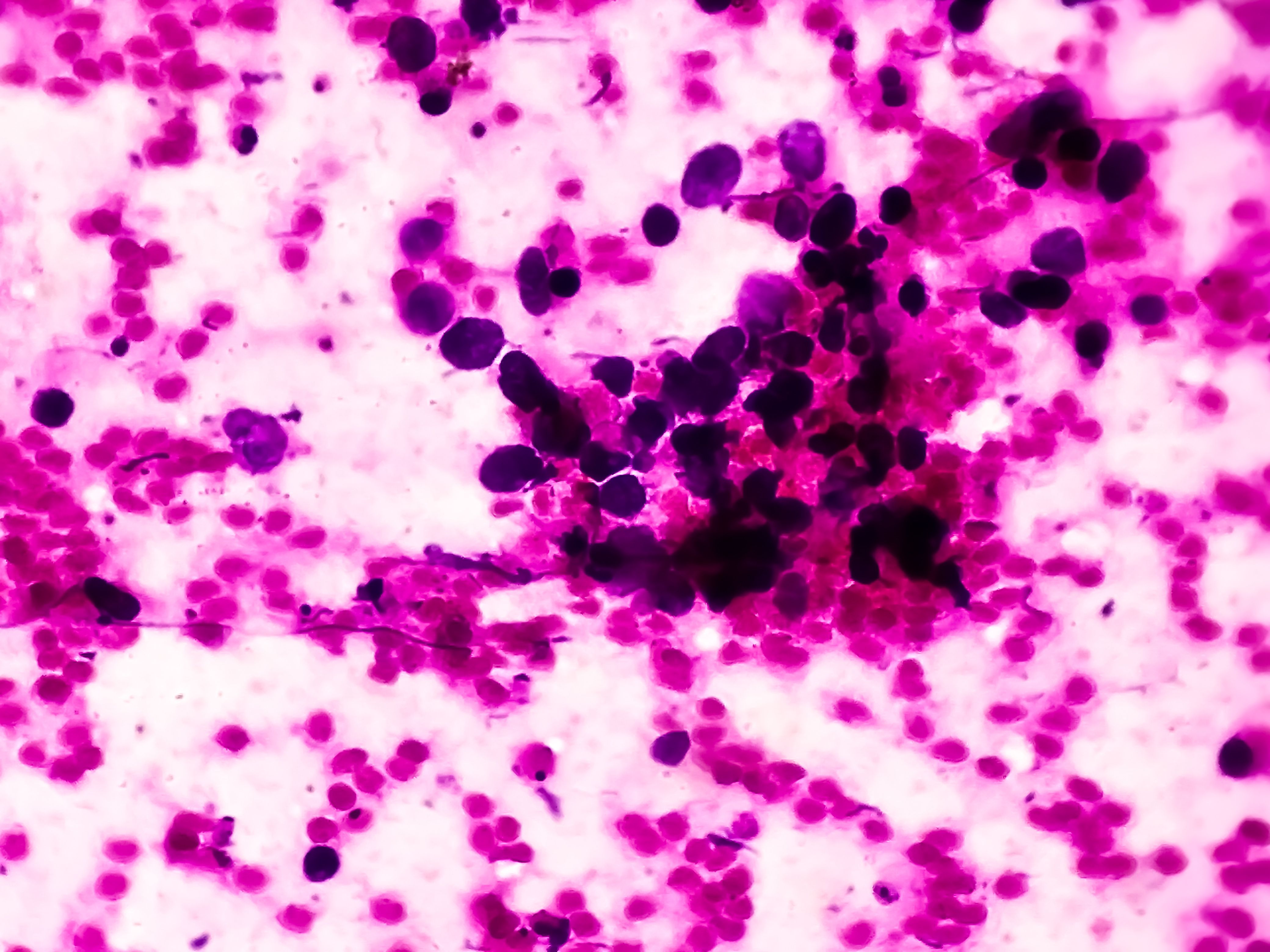 Small cell lung cancer (SCLC) -- Image credit: Arif Biswas | stock.adobe.com