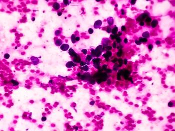 Small cell lung cancer (SCLC) -- Image credit: Arif Biswas | stock.adobe.com