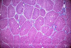 Study Data Shows Nivolumab Improves Overall Survival in Unresectable Advanced, Metastatic Esophageal Squamous Cell Carcinoma