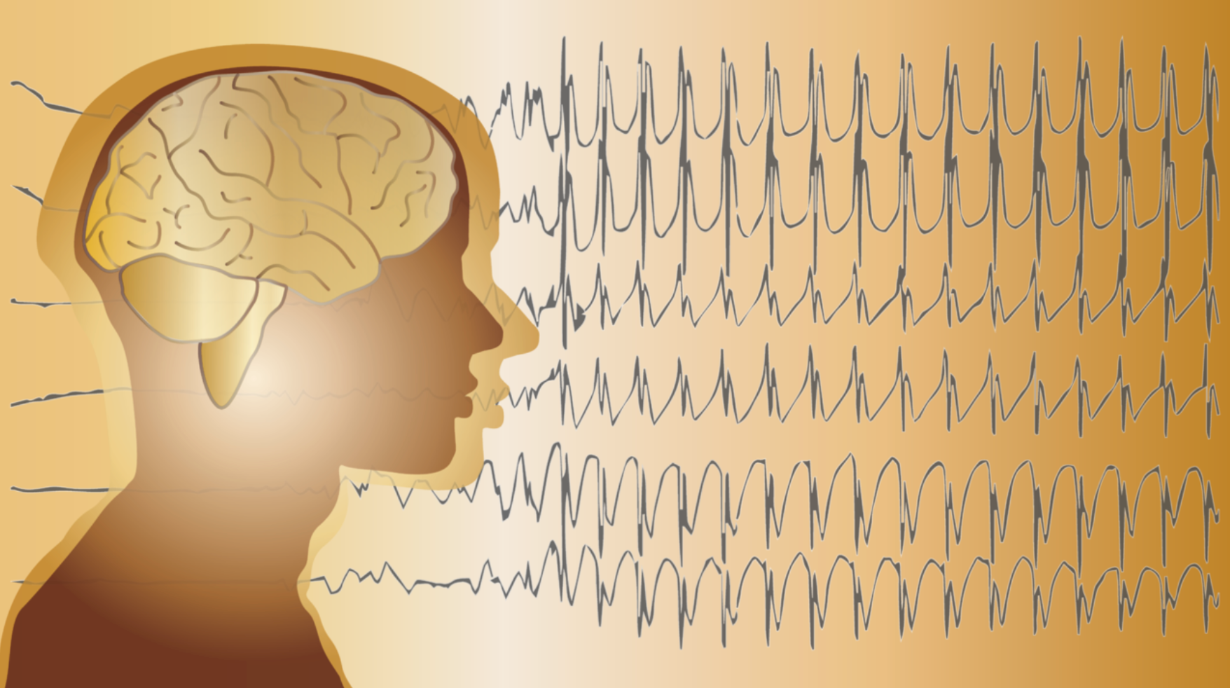 COVID-19 Found to Elevate Risk of Seizures More Than Influenza