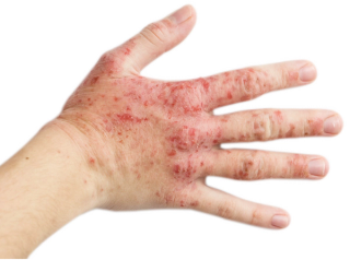 Pharmacist Medication Insights: Dupilumab for Atopic Dermatitis