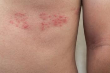 Detail of body skin with Herpes Zoster (Shingles) - Image credit: Sunday Cat Studio | stock.adobe.com