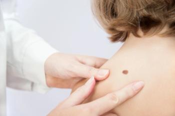Doctor examining a mole | Damian Gretka | stock.adobe.com