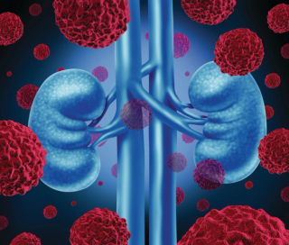 Pharmacist Medication Insights: Tivozanib for Renal Cell Carcinoma