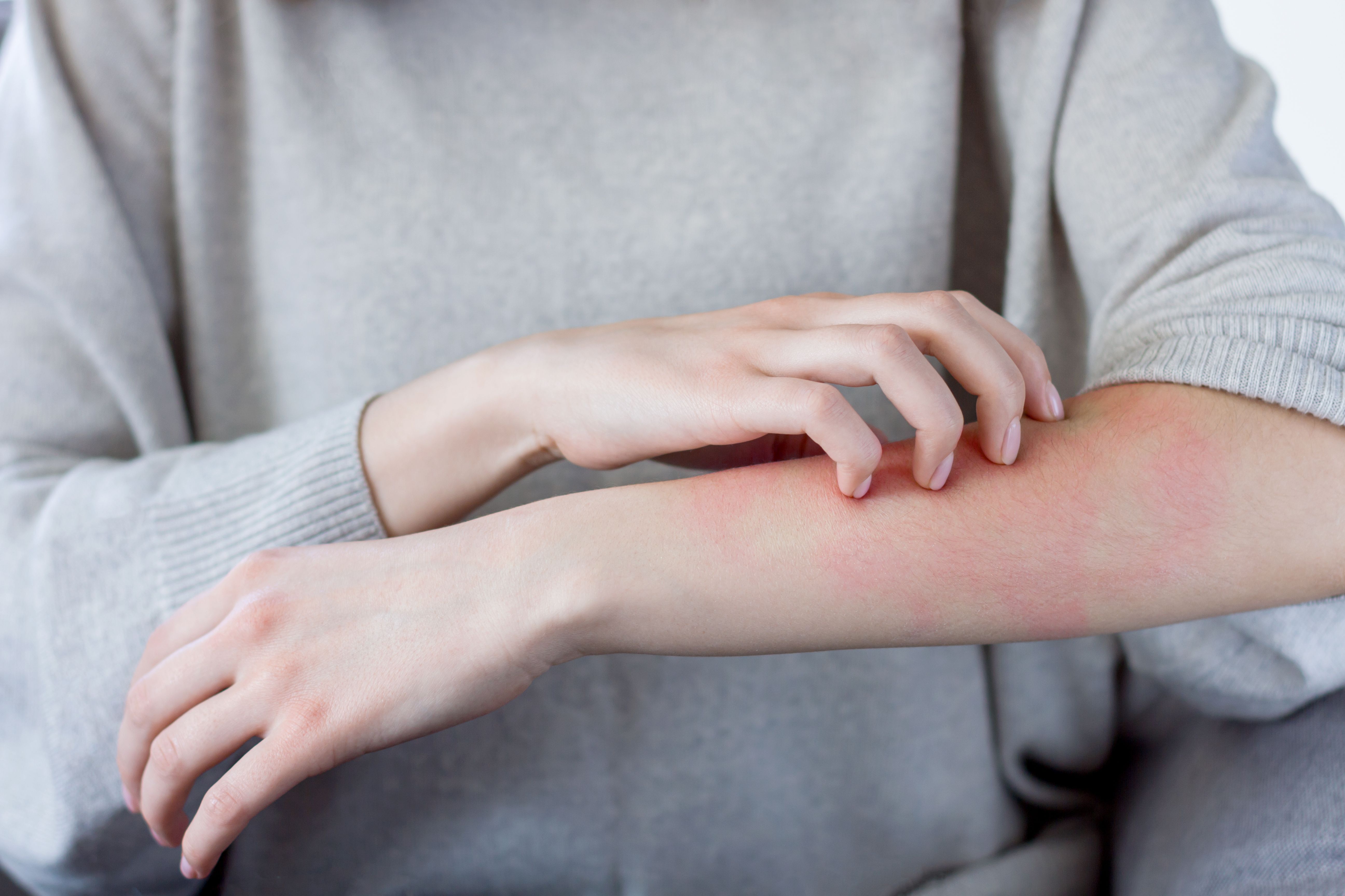 FDA Approves Tralokinumab-ldrm Autoinjector for Adults With Atopic Dermatitis