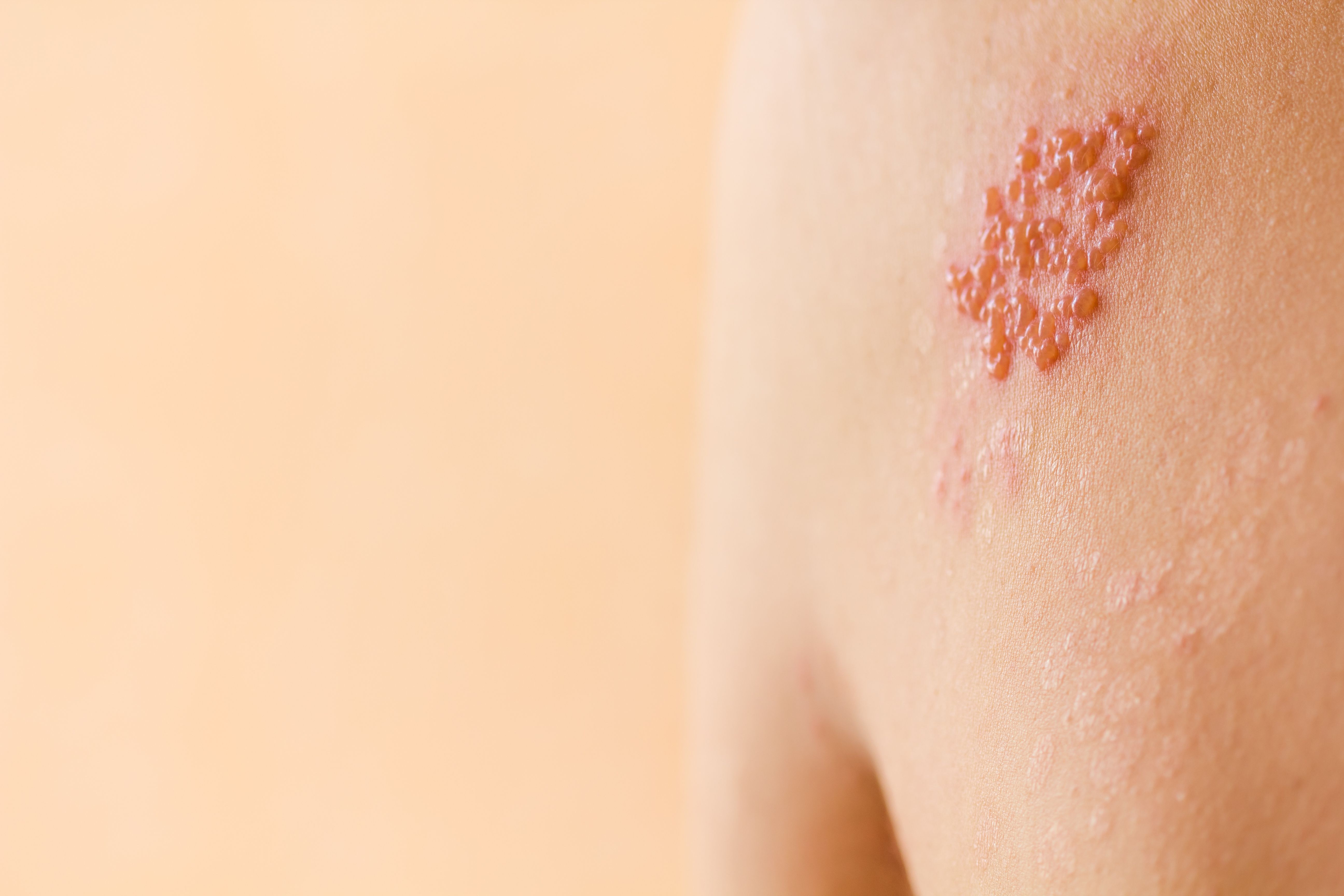 A Review of Treatment Options for Shingles