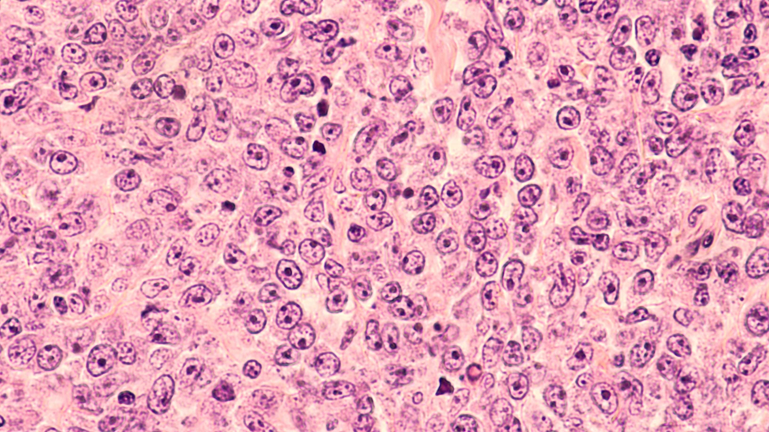 large B-cell lymphoma -- Image credit: David A Litman | stock.adobe.com