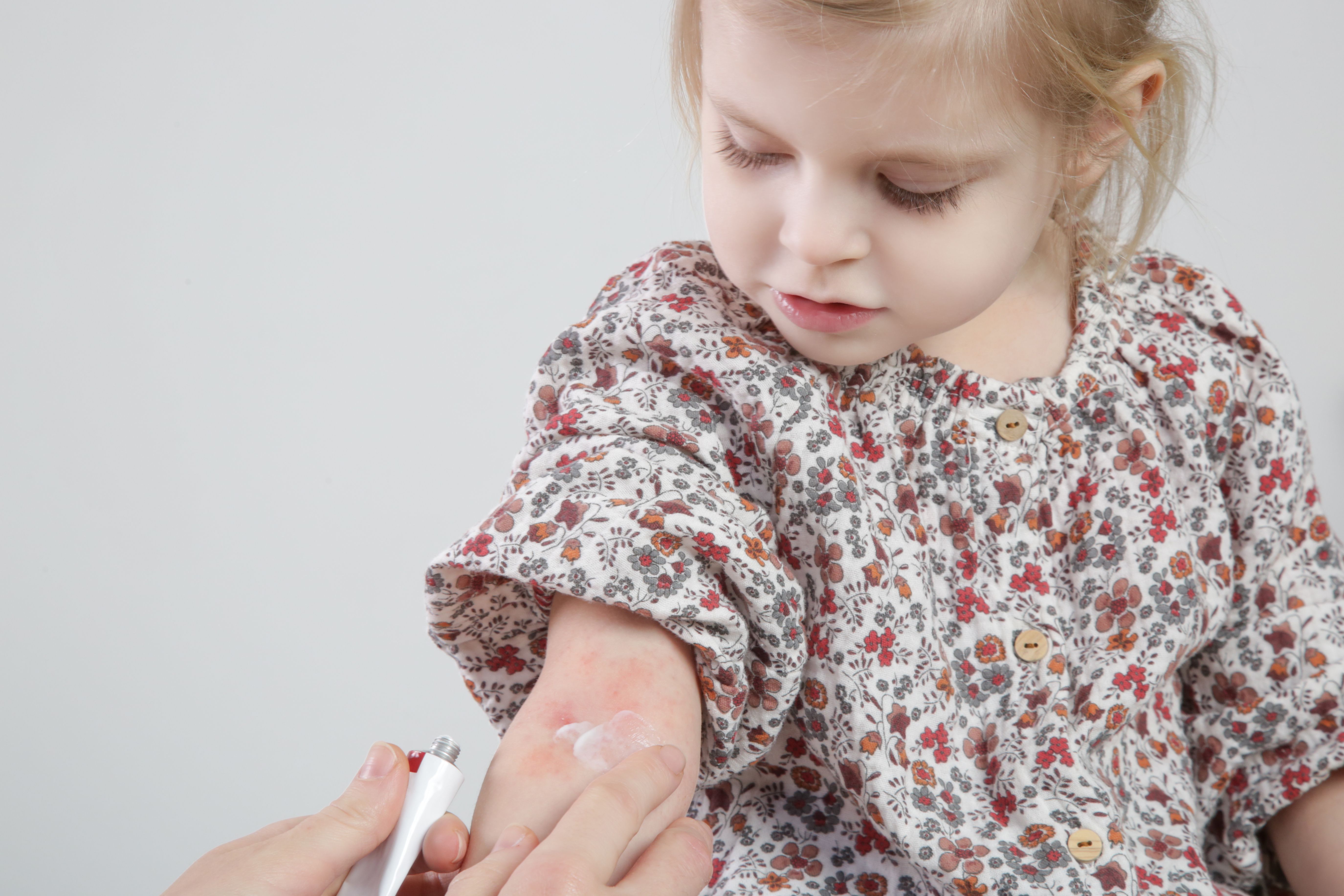 Young girl with atopic dermatitis -- Image credit: triocean | stock.adobe.com