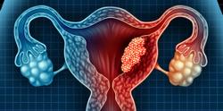 Monotherapy Demonstrates Promising Clinical Activity in Endometrial Cancer