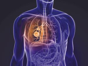 Neoadjuvant, Adjuvant Therapy for Resectable NSCLC Progresses With Immunotherapy, Targeted Therapy