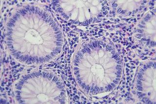 Precision Oncology in Focus: ctDNA's Role in Colon Cancer Management