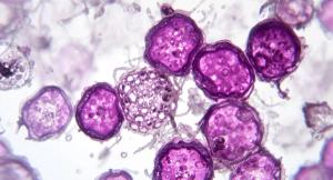 MRD-Guided Transplant Deferral Remains Feasible at Nearly 4 Years in MILESTONE Study