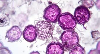 MRD-Guided Transplant Deferral Remains Feasible at Nearly 4 Years in MILESTONE Study