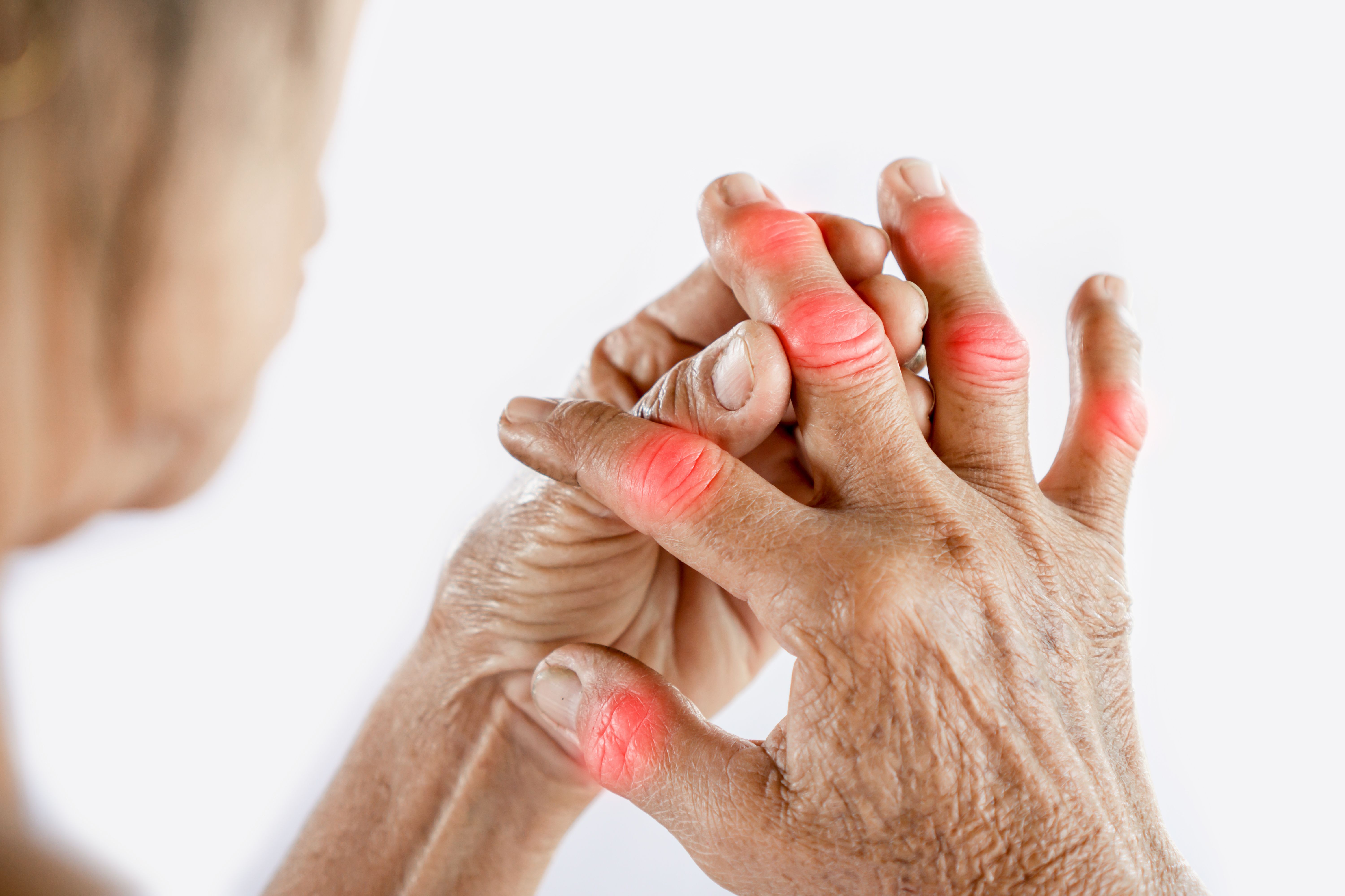 woman hand suffering from joint pain with gout in finger | Image Credit: doucefleur | stock.adobe.com  woman hand suffering from joint pain with gout in finger | Image Credit: doucefleur | stock.adobe.com