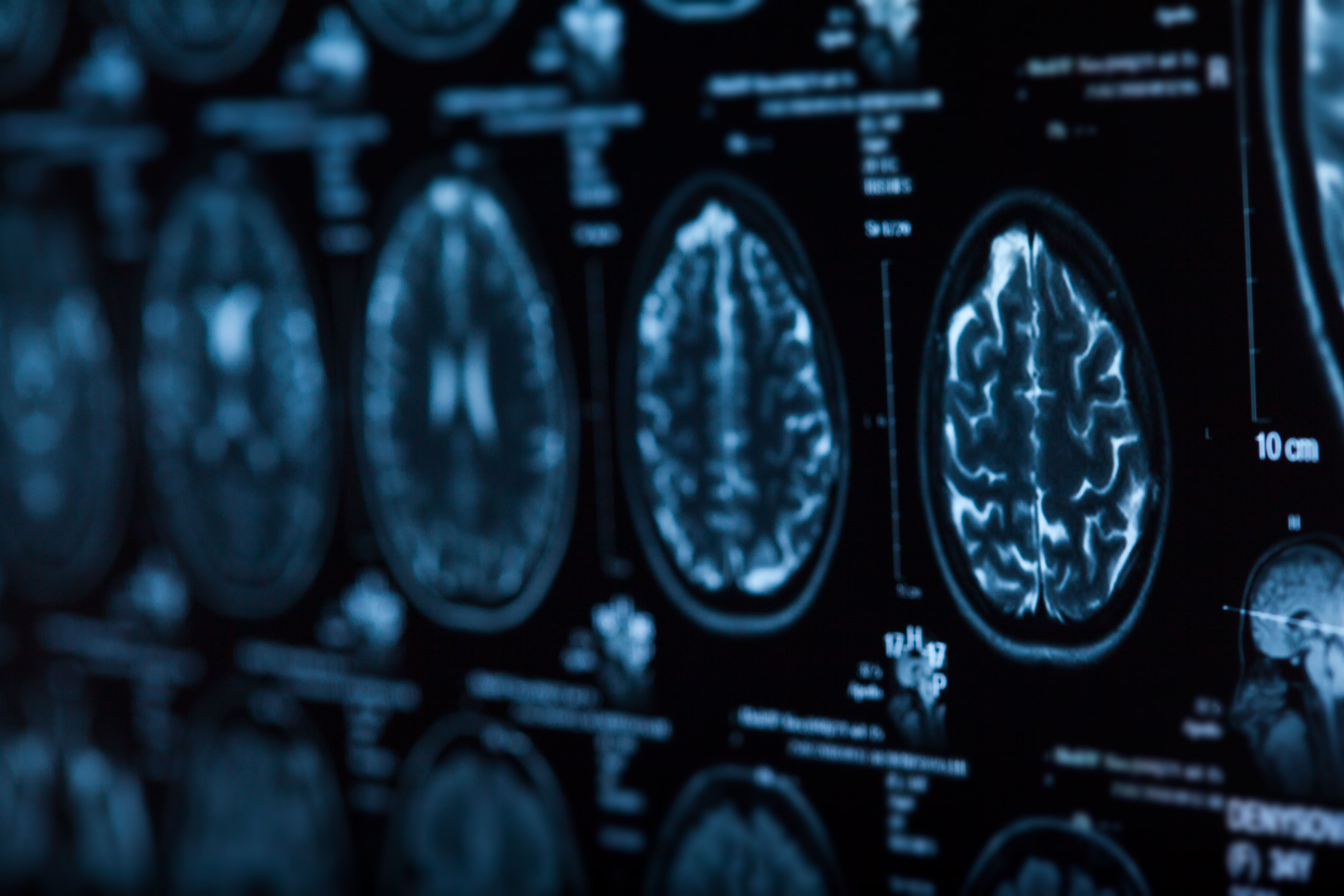 Scan of brain -- Image credit: merydolla | stock.adobe.com