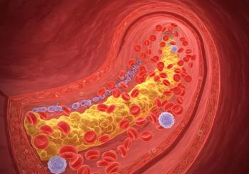 Medical Illustration Atherosclerosis, Cholesterol Plaque, Blood Clot in Artery, Cardiovascular Disease.