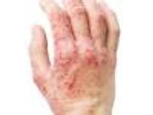 Long-Term Treatment with Apremilast Reduces Psoriatic Arthritis Symptoms