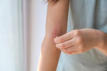 A girl scratches the skin on the elbow of her arm, redness is atopic dermatitis, the girl's face is not visible. - Image credit: Evgeniya Primavera | stock.adobe.com