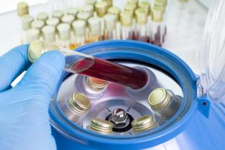 Common Manifestations of Congenital Plasminogen Deficiency and Their Impact on Patient Outcomes