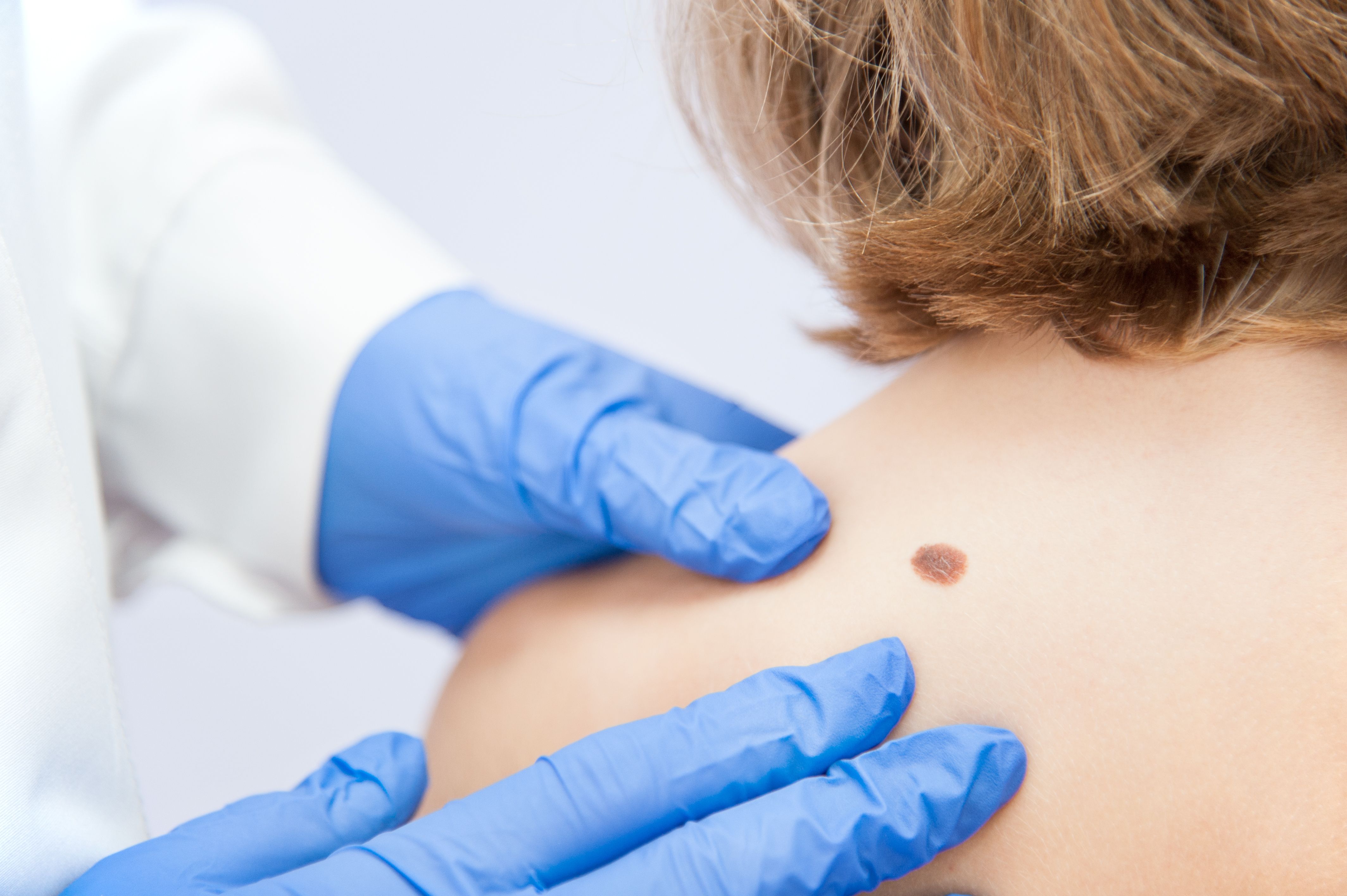 birthmark / A medical consultation at the Removal of nevus - Image credit: Damian Gretka | stock.adobe.com